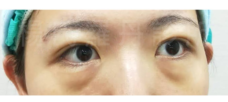 眼袋 淚溝 除眼袋