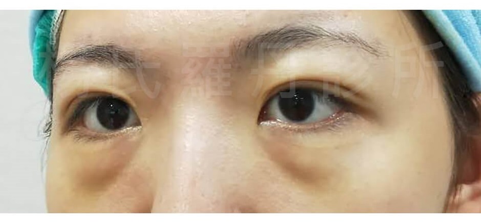 眼袋 除眼袋