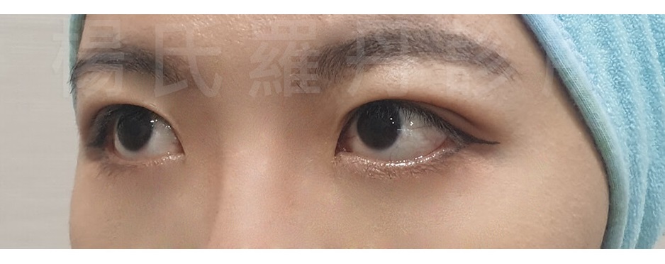 醫學美容 眼袋手術 眼袋