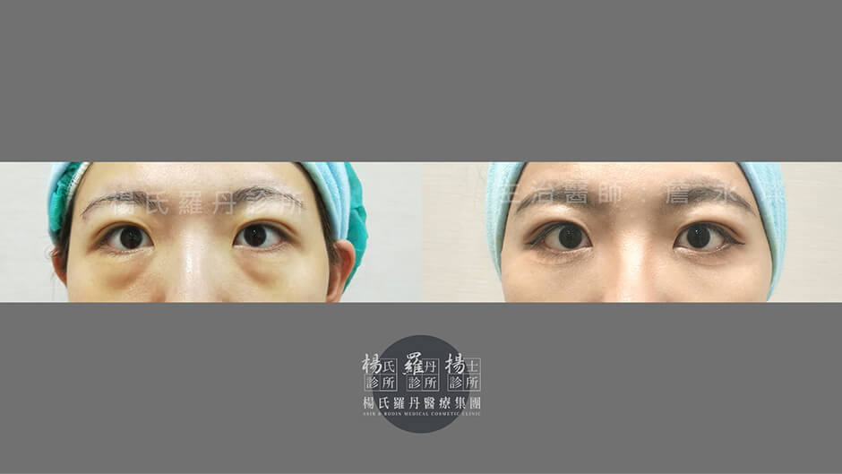 眼袋 除眼袋 醫學美容