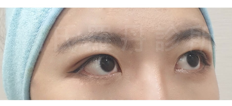 眼袋手術 眼袋 除眼袋