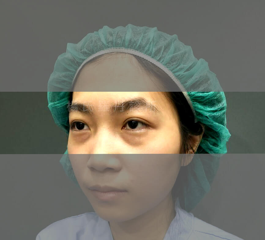 眼袋 淚溝 眼袋手術