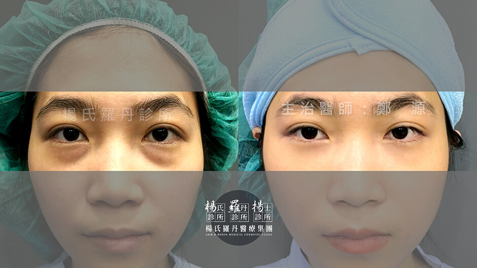 眼袋 眼袋手術 眼袋消除