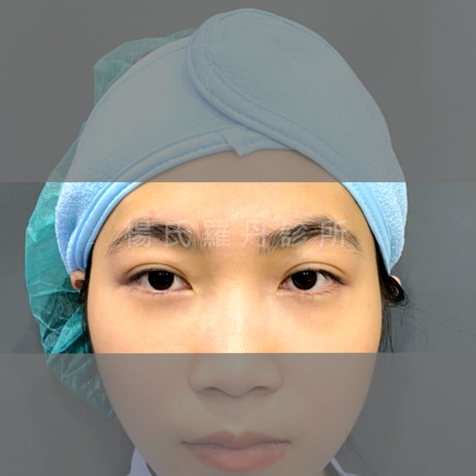 淚溝 眼袋 眼袋案例