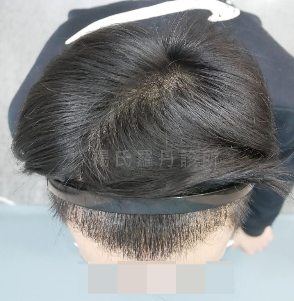 ARTAS 植髮  植髮效果 