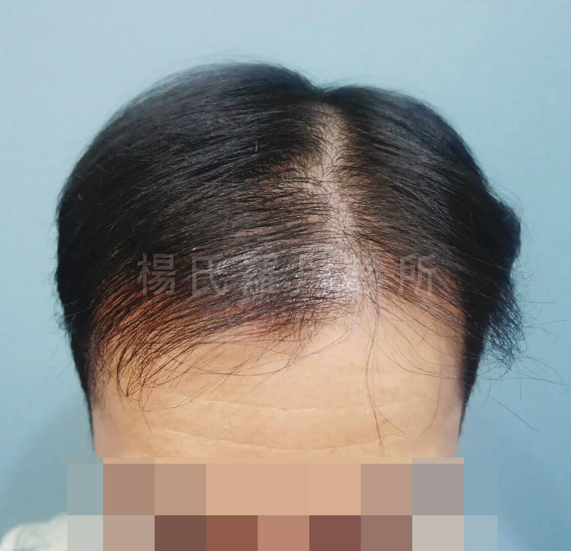 生髮治療 生髮 掉髮