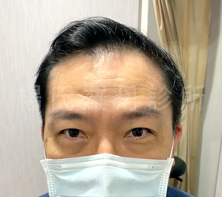 生髮 生髮治療 六合一三階段雄性禿治療 張泰山頭髮