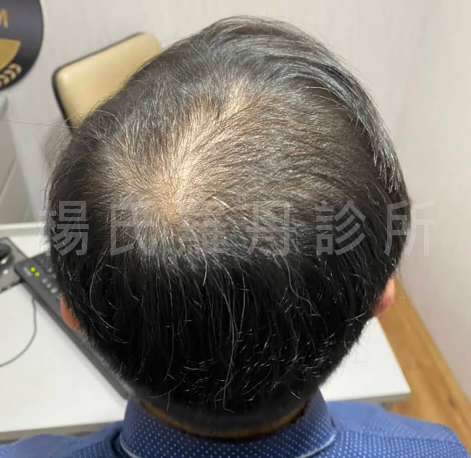 生髮治療 生髮 六合一三階段雄性禿治療