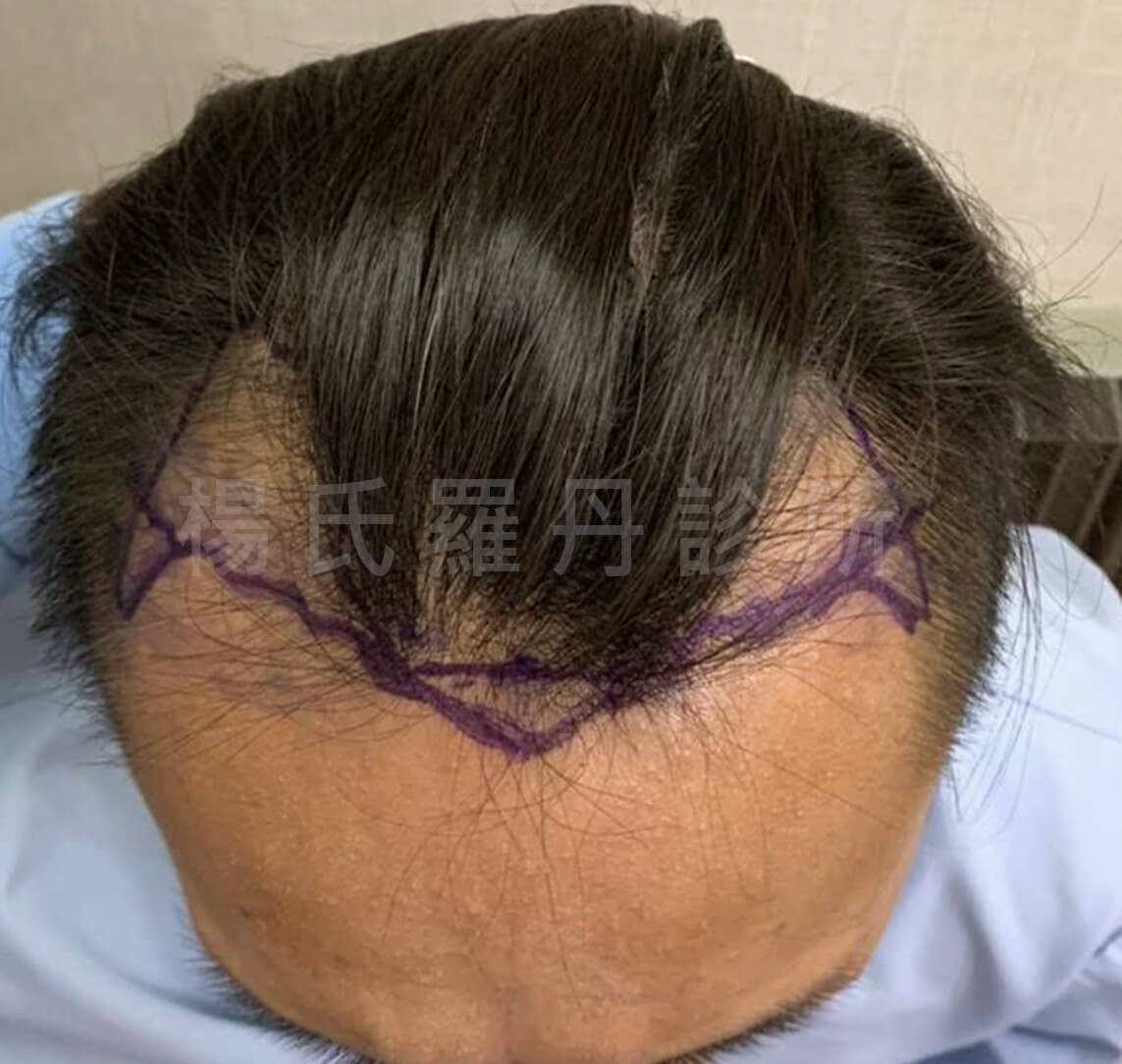 落髮 禿頭 禿頭治療