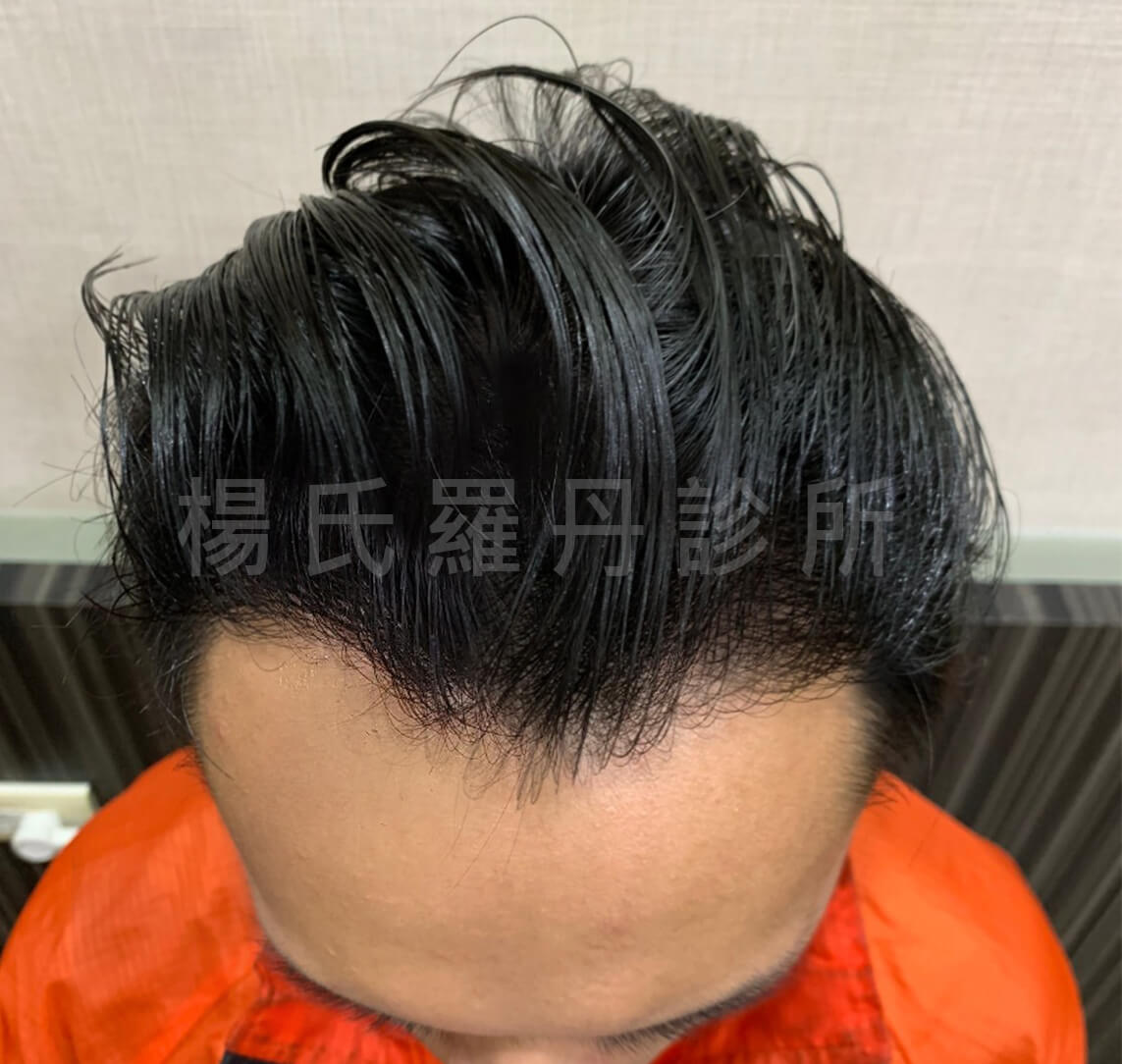 M型禿 植髮 禿頭