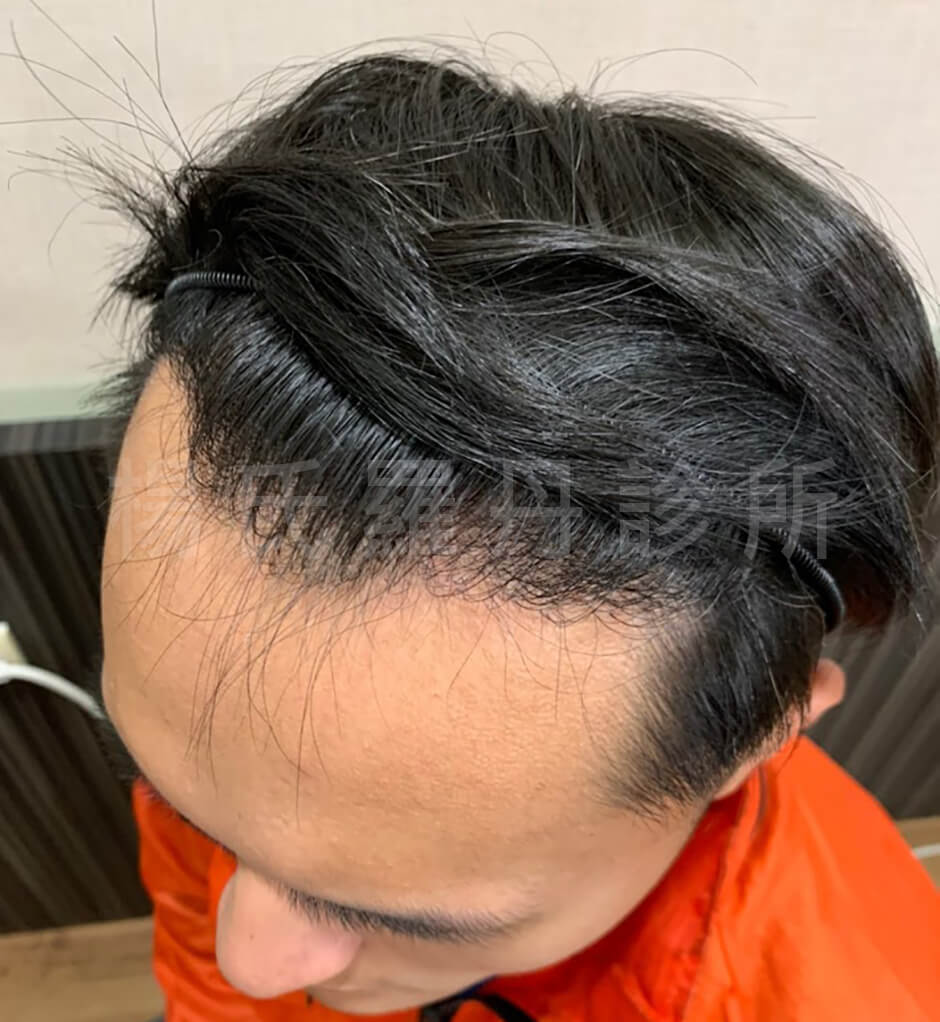 落髮 植髮 禿頭