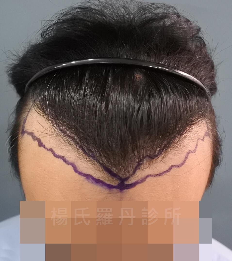 植髮 禿頭 治療禿頭