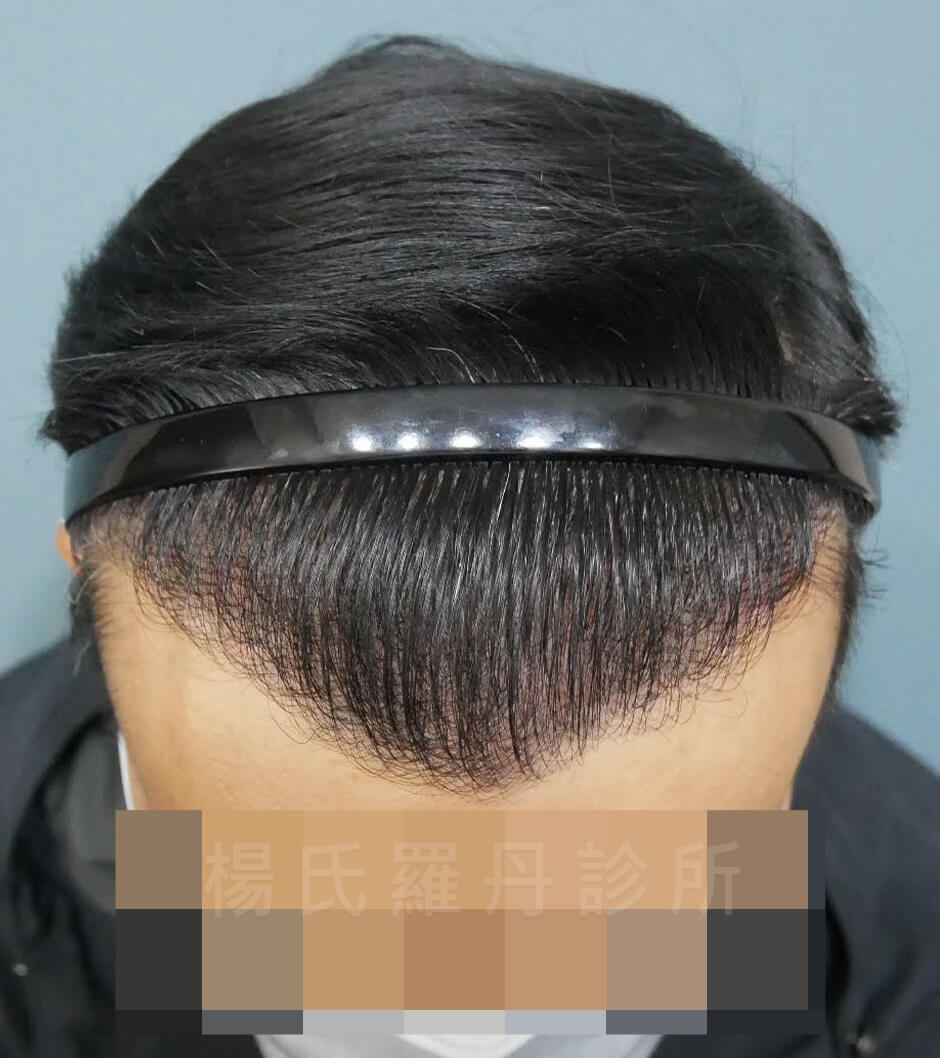 禿頭 M型禿 植髮