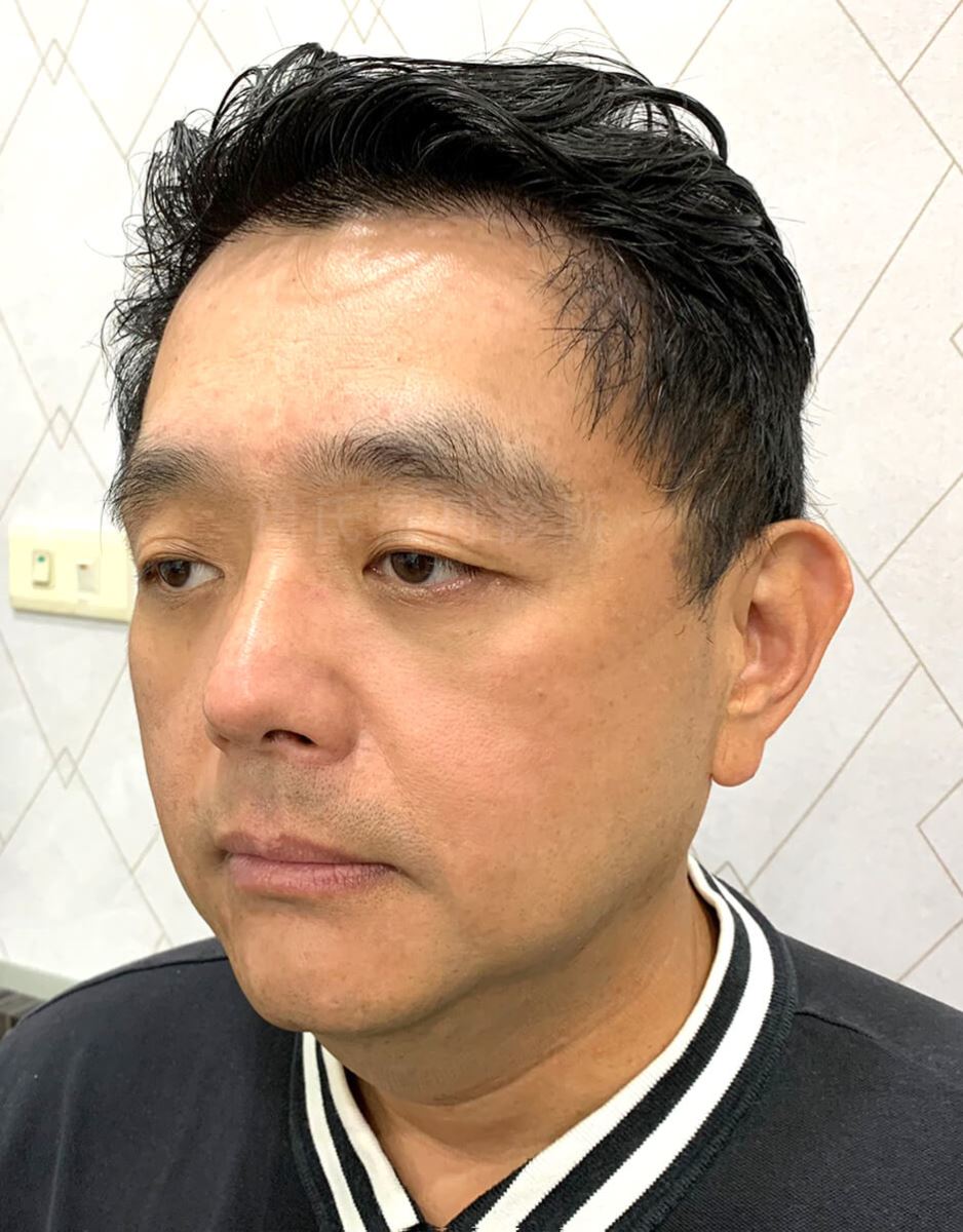 除眼袋 眼袋手術 眼袋