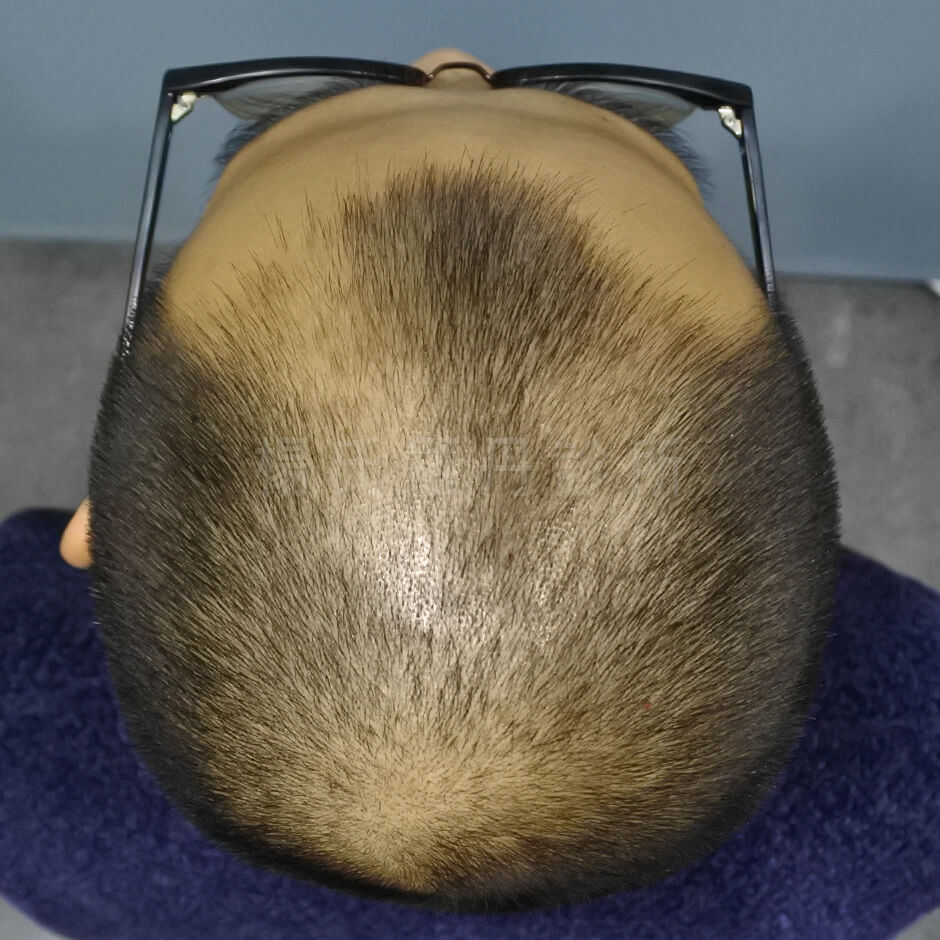 植髮效果 植髮 植髮手術