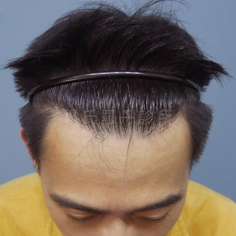 掉髮 植髮 植髮手術