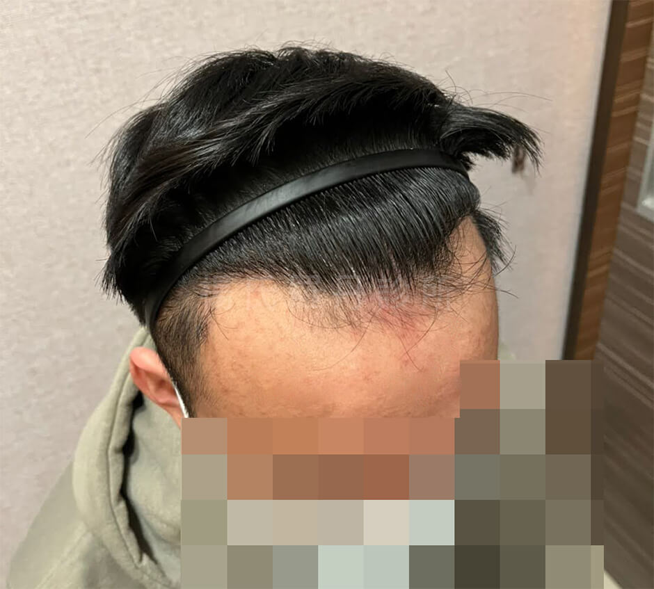 植髮 掉髮 植髮案例