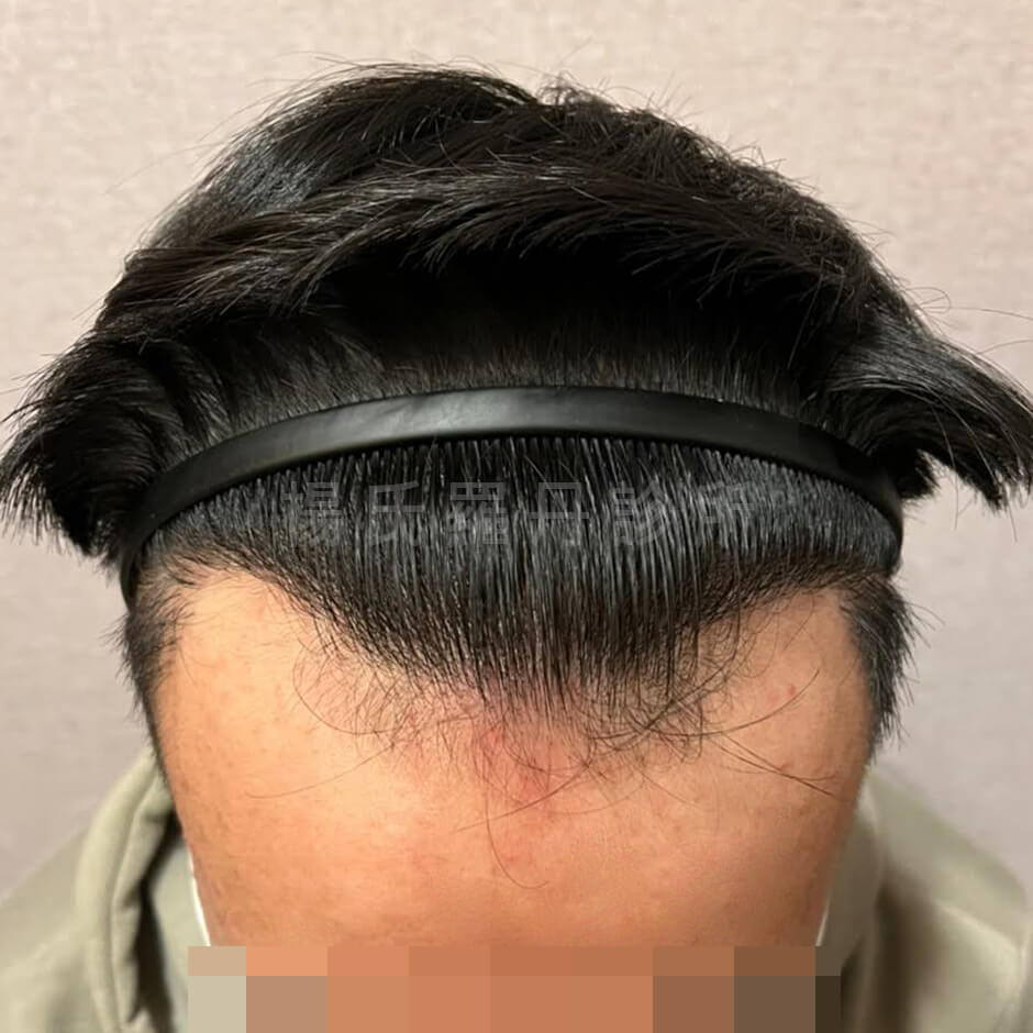 禿頭 植髮 