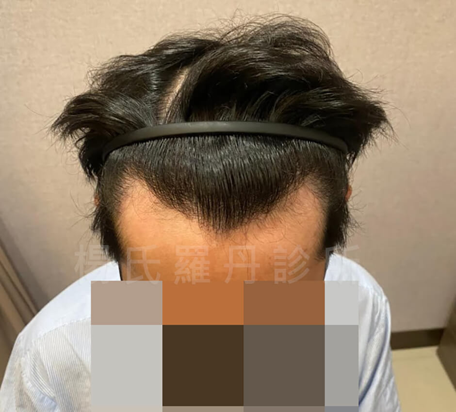 雄性禿 禿頭 解決禿頭