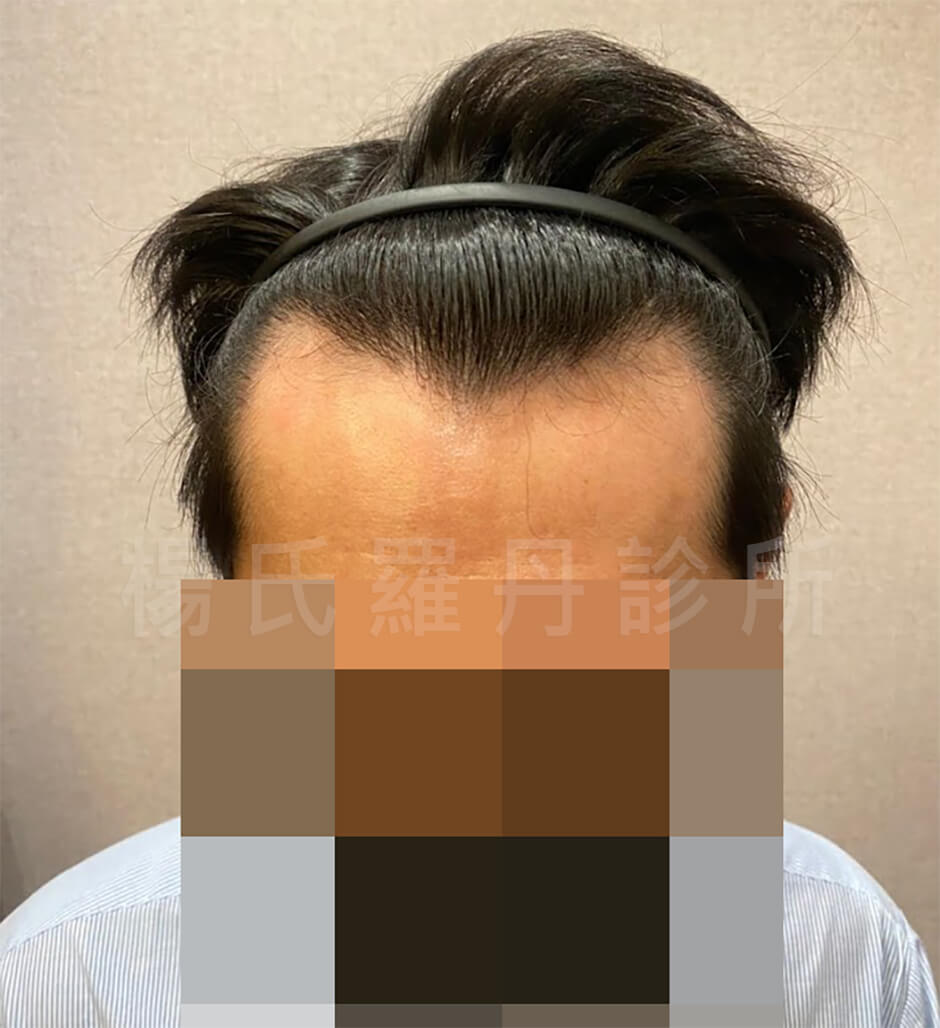 雄性禿 禿頭 植髮