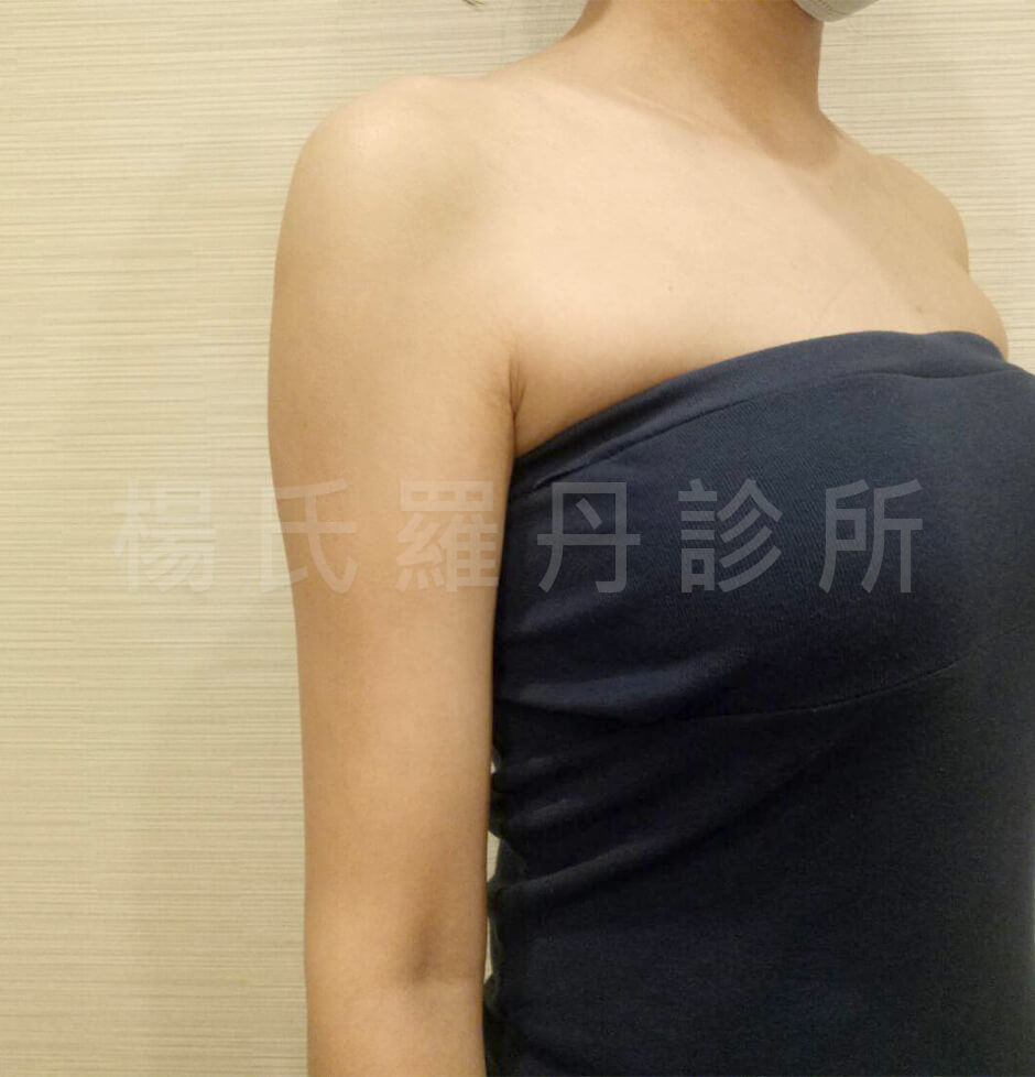 瘦手臂 雷射減脂 贅肉