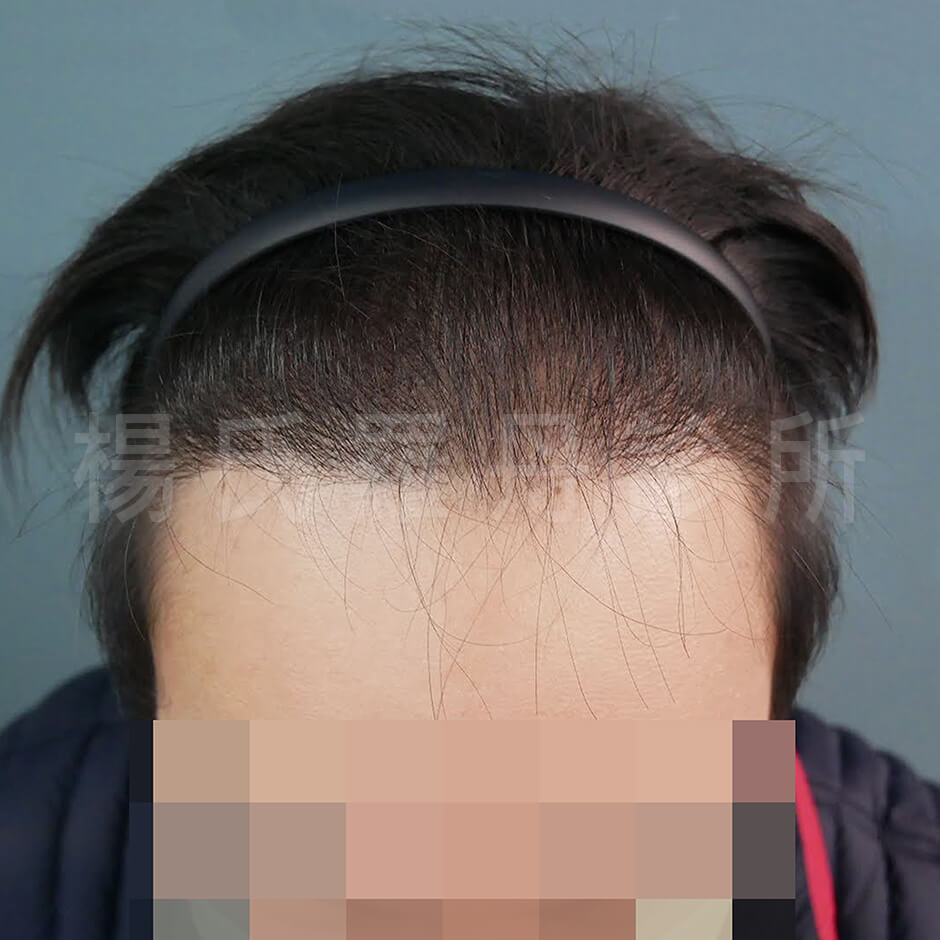 植髮手術 植髮 禿頭