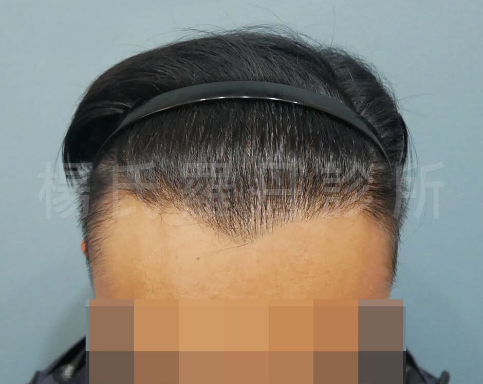 植髮 植髮成果 掉髮