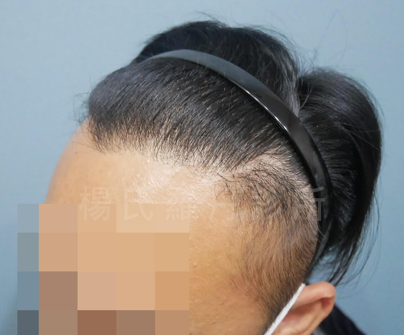 掉髮 植髮手術 植髮