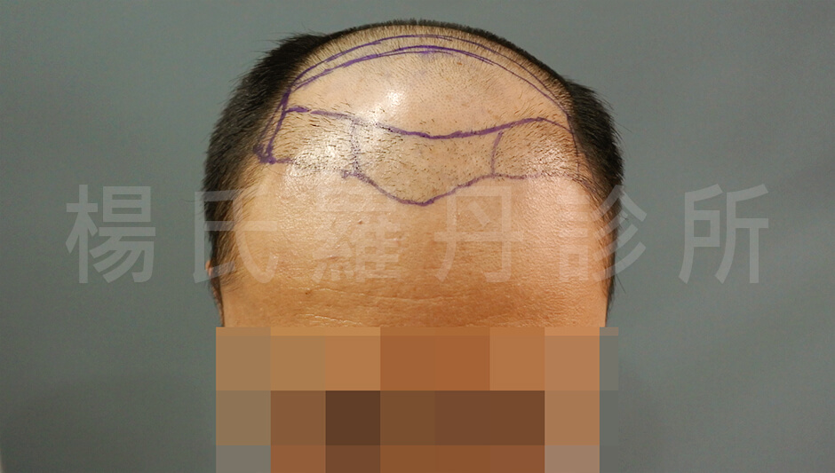 禿頭 植髮手術 植髮