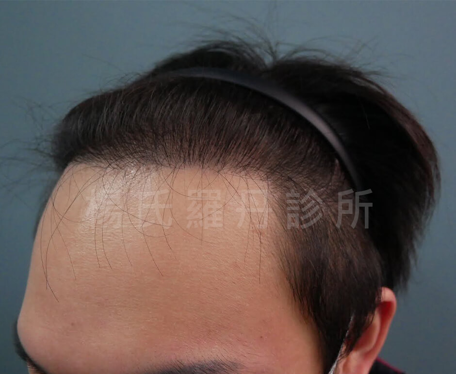 植髮 禿頭 植髮效果
