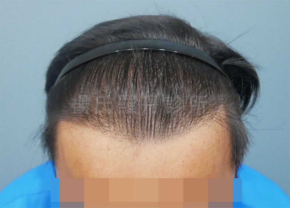 植髮效果 植髮 植髮手術
