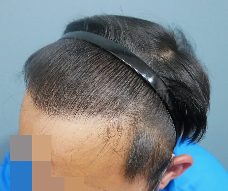 禿頭 掉髮 改善掉髮