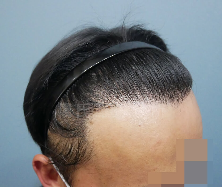 禿頭 落髮 植髮