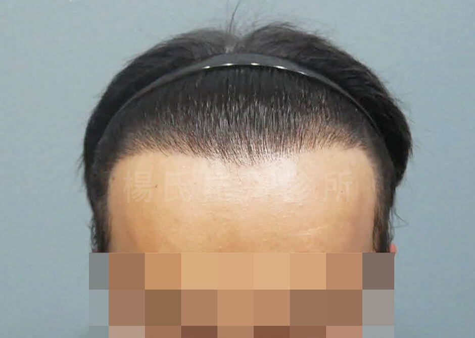 植髮手術 植髮 禿頭