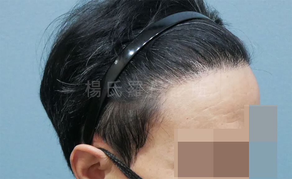 禿頭 髮際線 禿頭治療