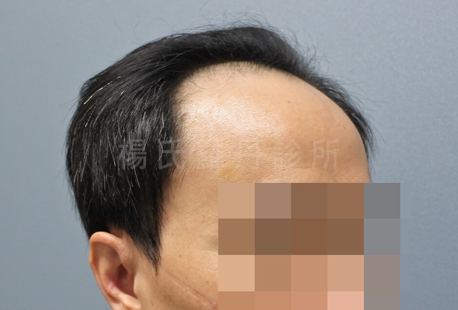 植髮推薦 髮際線 植髮