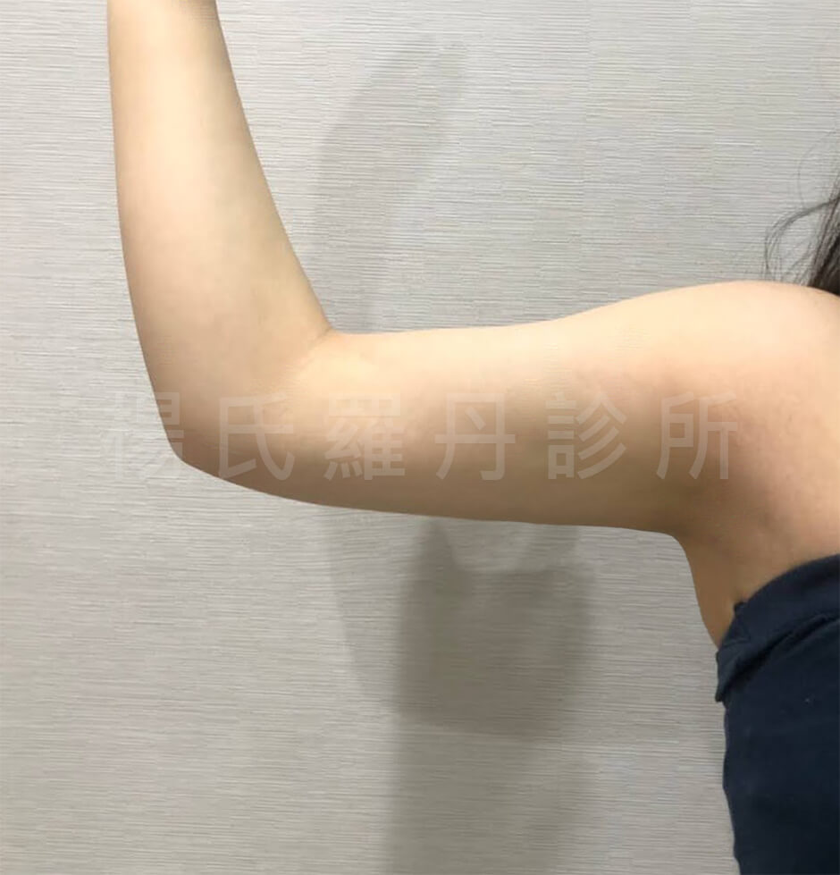瘦手臂 雷射減脂 掰掰袖
