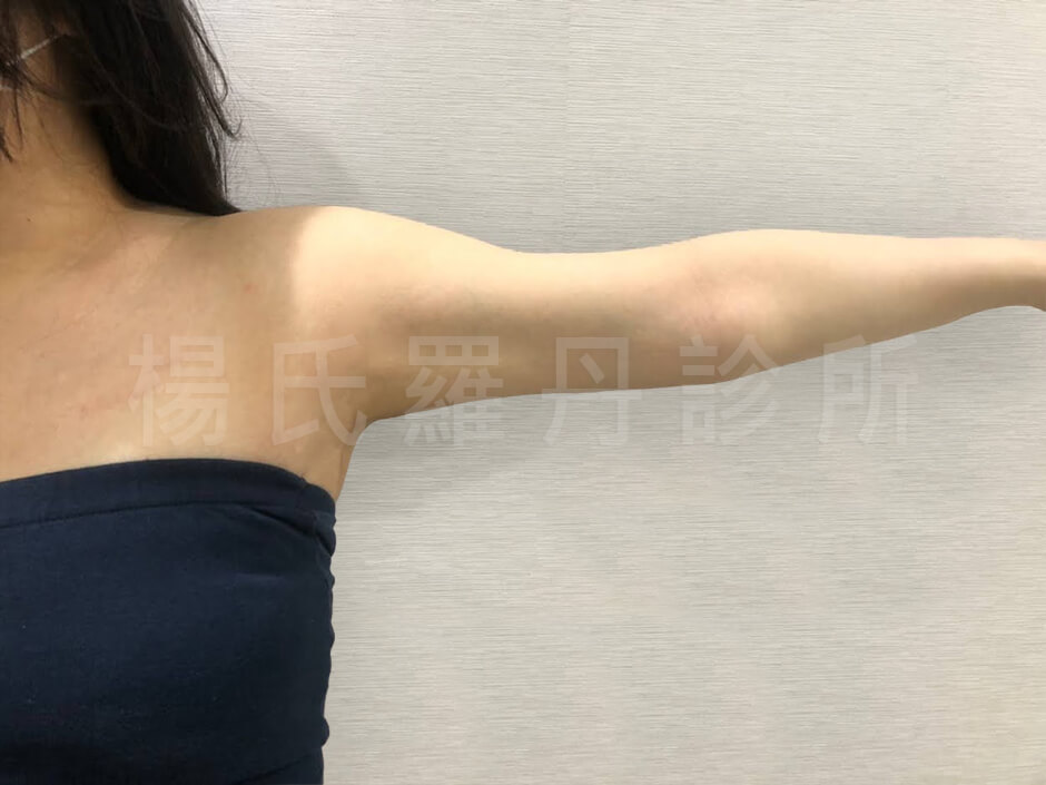 雕塑 瘦手臂 雷射減脂