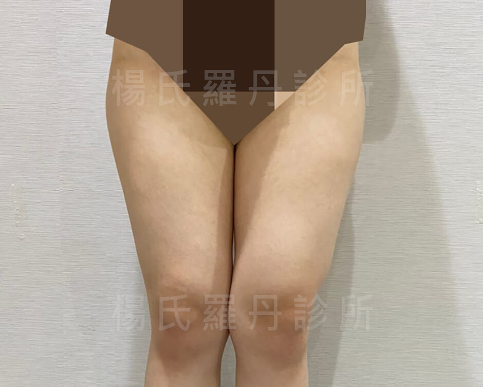 抽脂 雷射減脂 馬鞍