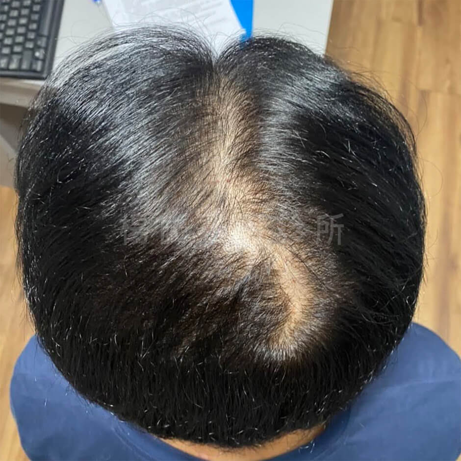 生髮效果 生髮 落髮 六合一三階段雄性禿治療