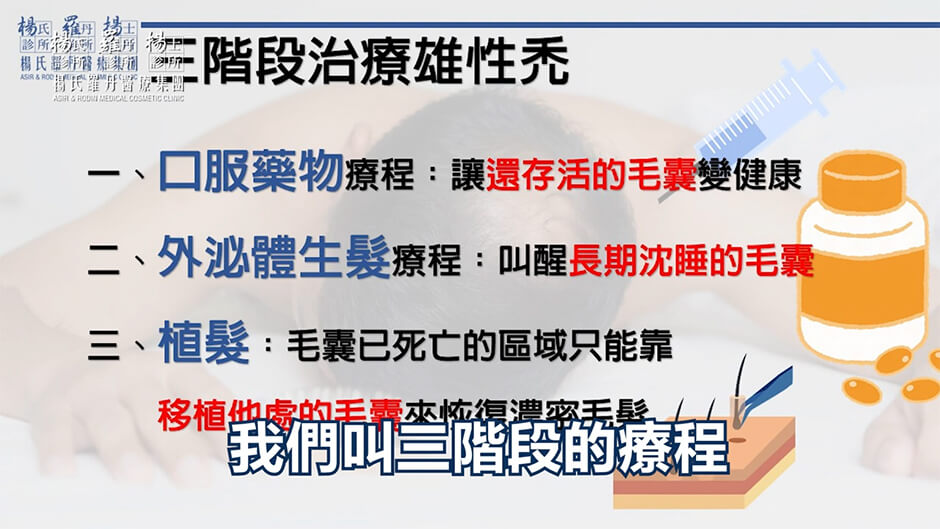 三階段治療雄性禿 外泌體 生髮 生髮療程