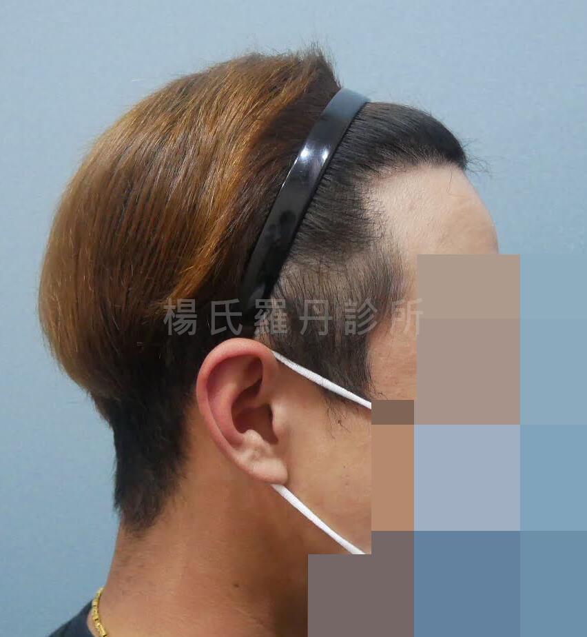 植髮 植髮成果 禿頭