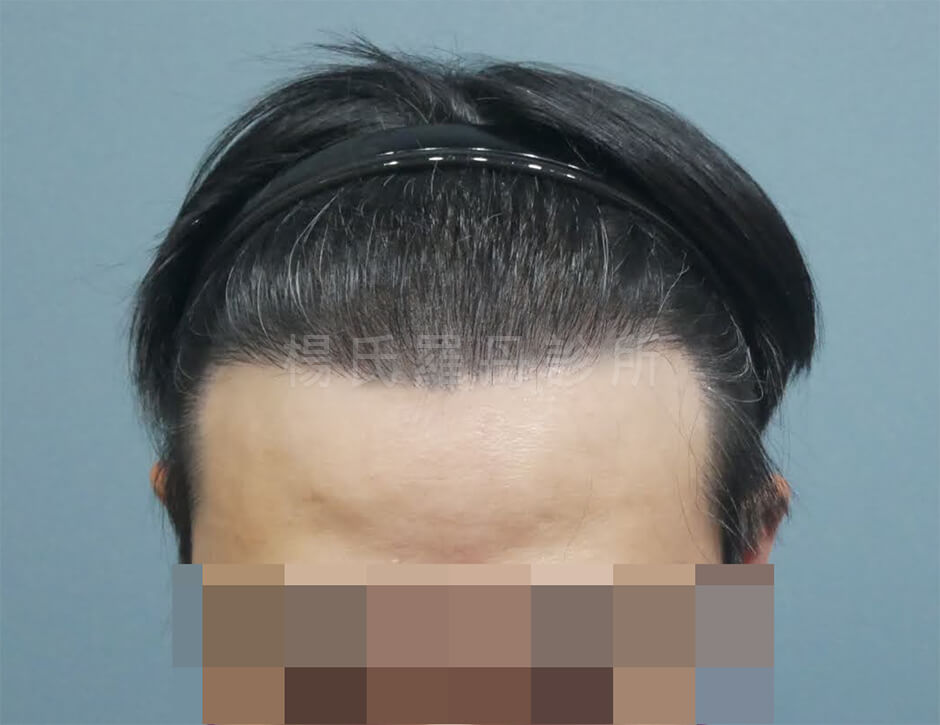 植髮手術 落髮 植髮