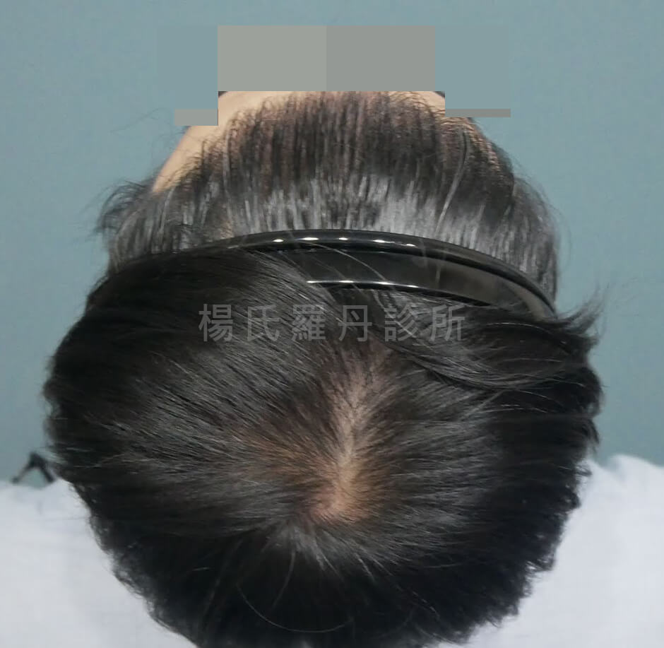 植髮 植髮效果 植髮案例