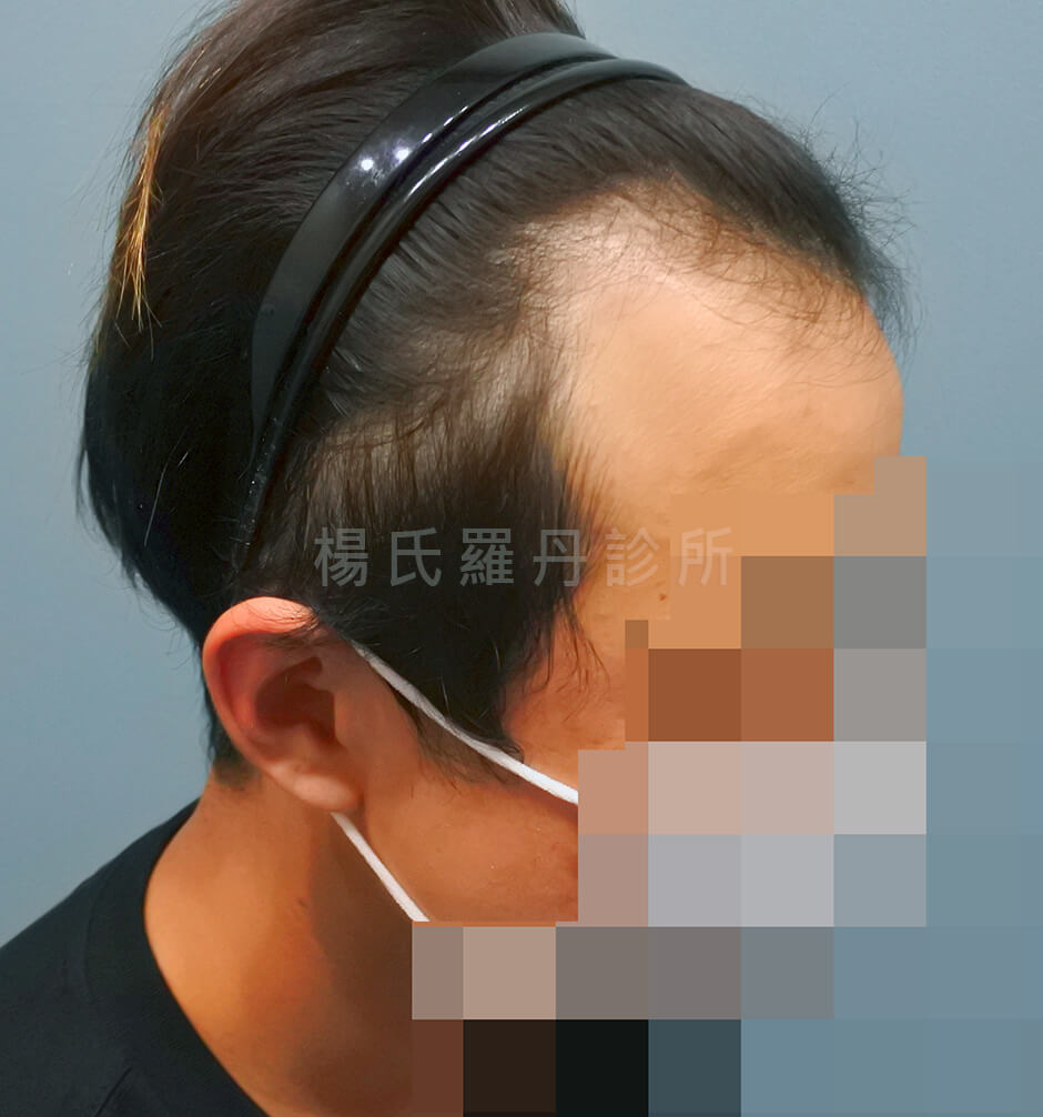 禿頭 落髮 植髮