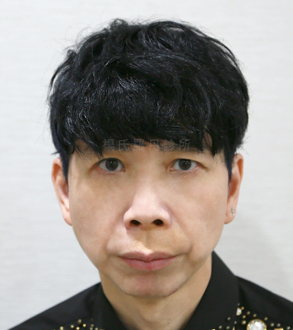 鼻雕 鼻型調整 陳其偉