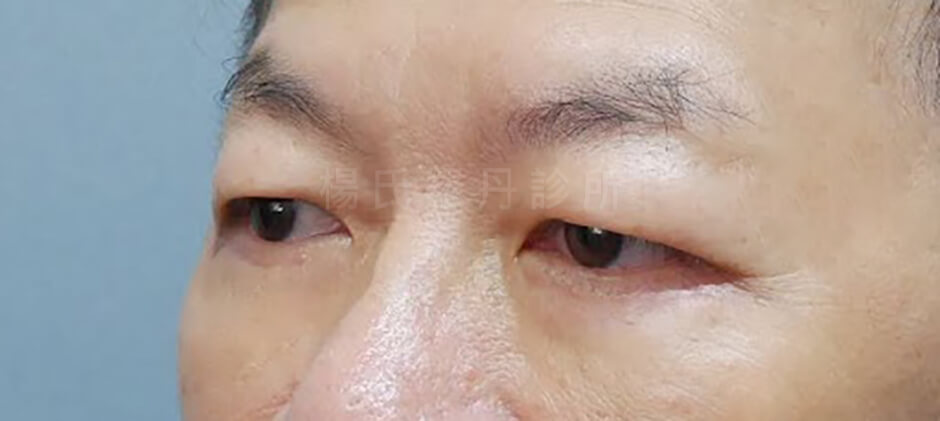 除眼袋 醫學美容 楊氏羅丹