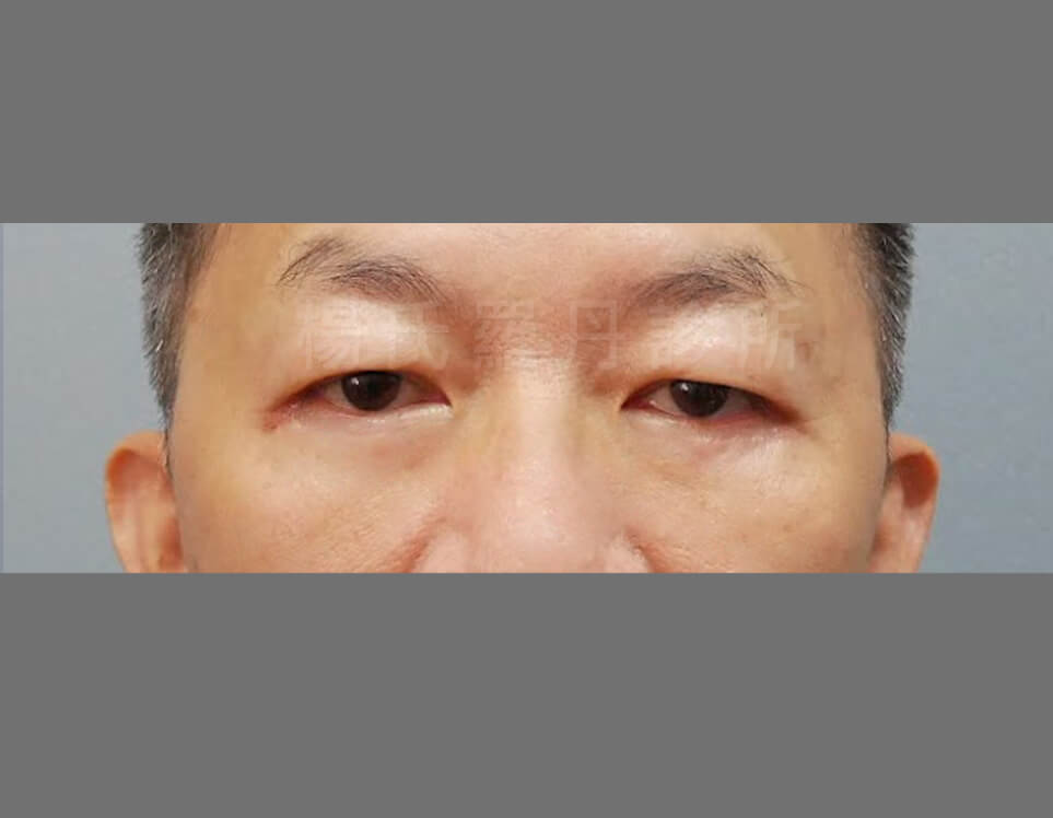 除眼袋 眼袋 淚溝