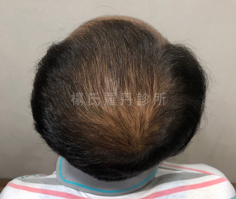生髮 禿頭 外泌體 六合一三階段雄性禿治療