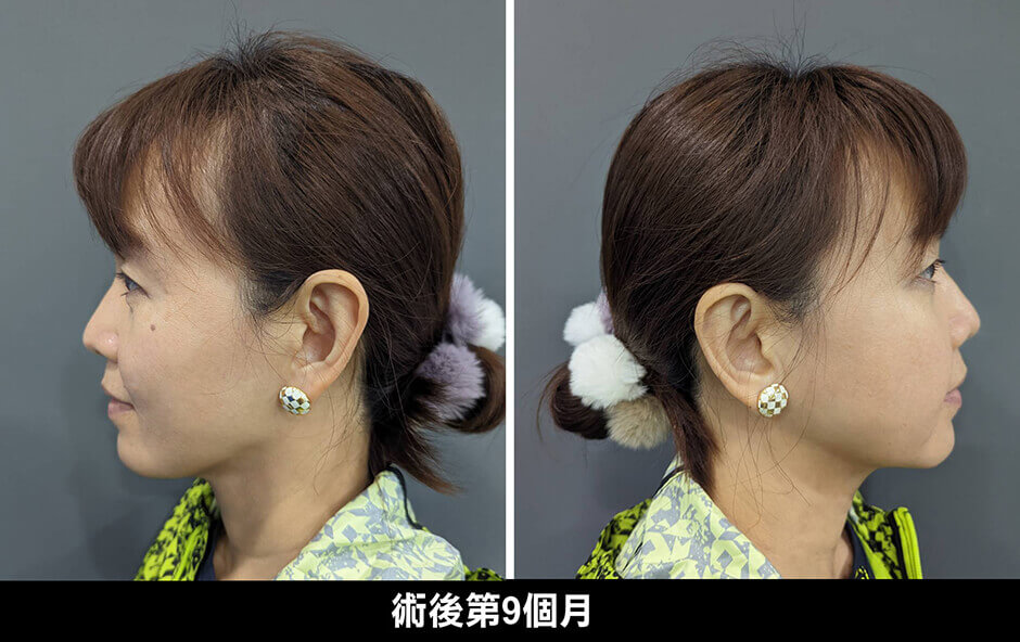 下巴抽脂 抽脂肪 下巴